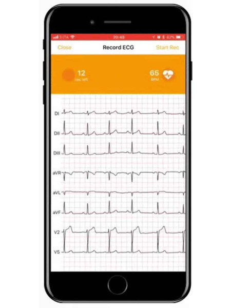 ECG connecté